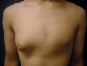Chicago Gynecomastia